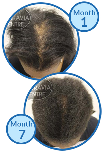 FDS hair loss treatment success story Belgravia Centre central cicatricial centrifugal alopecia