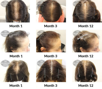 alert female pattern hair loss and trichotillomania the belgravia centre TS 15 02 2019