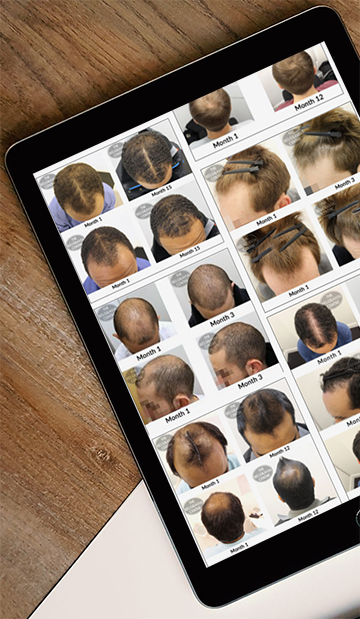Male-Pattern-Baldness-Hair-Loss-Treatment-Success-Stories-Belgravia-Centre-London