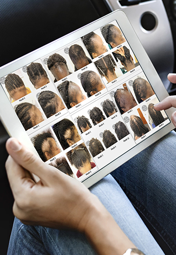 Traction Alopecia treatment hair growth success stories Belgravia Centre hair loss clinic