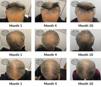 alert male pattern hair loss the belgravia centre FG 11 02 2019