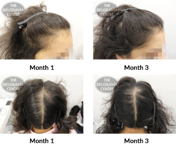 alert female pattern hair loss the belgravia centre NB 05 02 2019