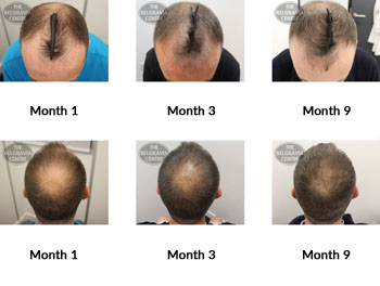 alert male pattern hair loss the belgravia centre RC 11 02 2019 1