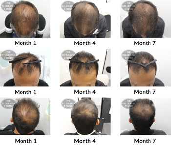 alert male pattern hair loss the belgravia centre CF 07 02 2019