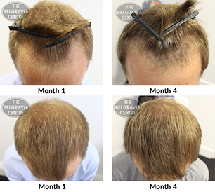 ALERT male pattern hair loss treatment before and after success story the belgravia centre AL 04 02 2019