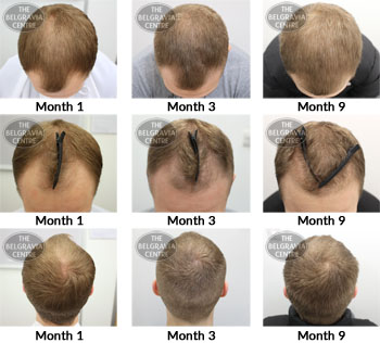 alert male pattern hair loss the belgravia centre AF 25 01 2019