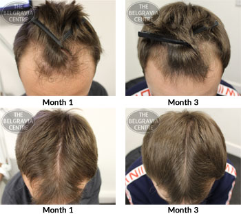 alert male pattern hair loss the belgravia centre SG 23 01 2019