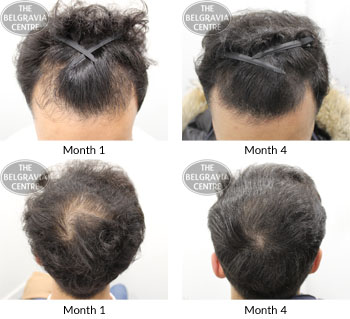 alert male pattern hair loss the belgravia centre SM 17 01 2019