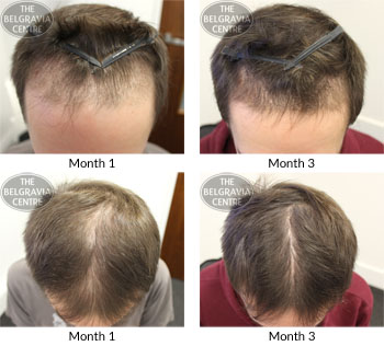alert pattern hair loss the belgravia centre MG 11 01 2019