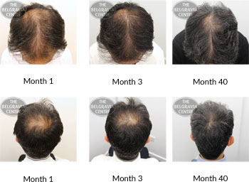 alert male pattern hair loss the belgravia centre SR 10 01 2019
