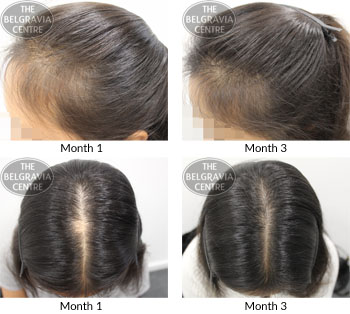 alert female pattern hair loss and alopecia areata the belgravia centre 09 01 2019