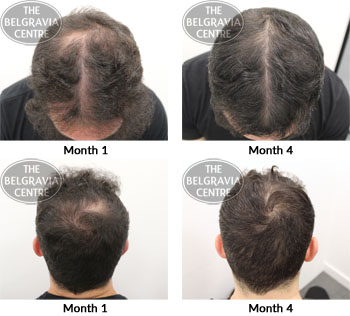 alert male pattern hair loss the belgravia centre AS 04 01 2019 2