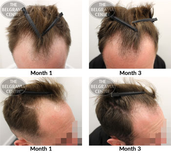 alert male pattern hair loss the belgravia centre 03 01 2019