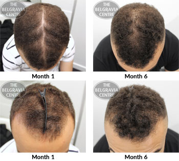 alert male pattern hair loss the belgravia center 12 12 2018