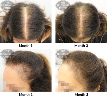 alert female pattern hair loss the belgravia centre 28 11 2018