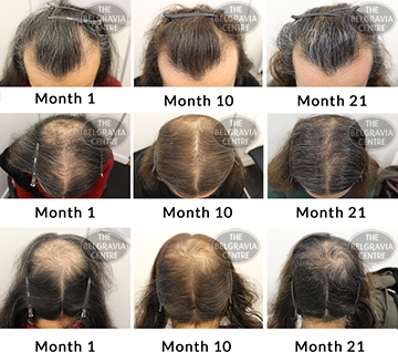 ALERT success story male pattern hair loss treatment belgravia centre men fr 26 11 2018