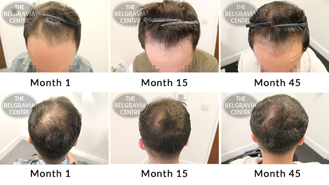 ALERT success story male pattern hair loss treatment belgravia centre men ag 20 11 2018