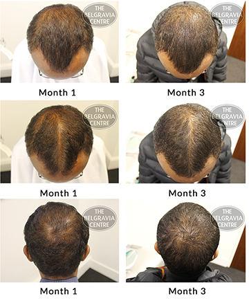 ALERT success story male pattern hair loss treatment belgravia centre 14 11 2018