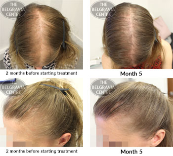 alert female pattern hair loss the belgravia centre 08 11 2018