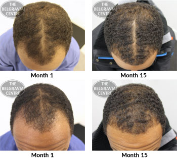 alert male pattern hair loss the belgravia centre 01 11 2018