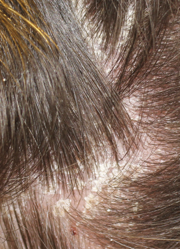 seborrhoeic dermatitis sebderm itchy flaky scalp