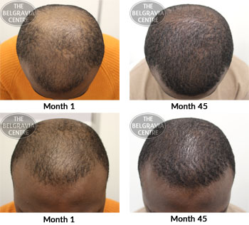 alert male pattern hair loss the belgravia centre 26 10 2018