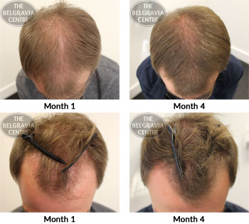 alert male pattern hair loss the belgravia centre 24 10 2018