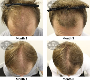 alert male pattern hair loss the belgravia centre 22 10 2018