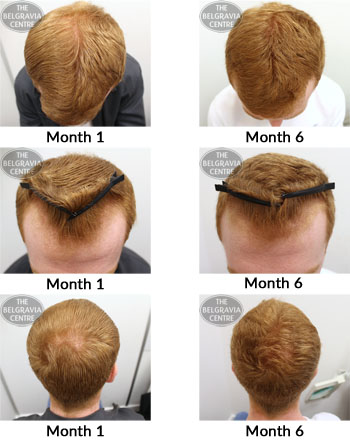 Success Story Alert! New Male Hair Loss Treatment Entry