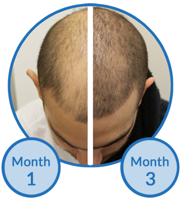 Success Story Belgravia Centre Male Hair Loss Treatment Thinning on Top
