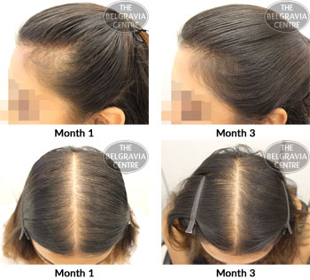 alert female pattern hair loss the belgravia centre 03 10 2018
