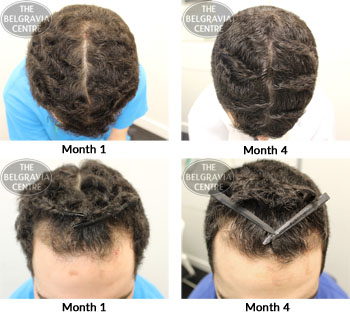 alert male pattern hair loss the belgravia centre 08 10 2018