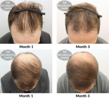 alert male pattern hair loss the belgravia centre 05 10 2018