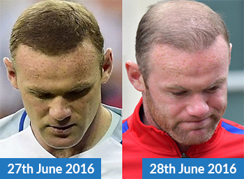 Wayne Rooney and Hair Loss Concealer Fibres