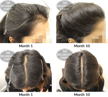 alert female pattern hair loss the belgravia centre 02 10 2019