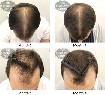 alert male pattern hair loss the belgravia centre 24 09 2018