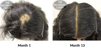 alert alopecia areata the belgravia centre 17 09 2018