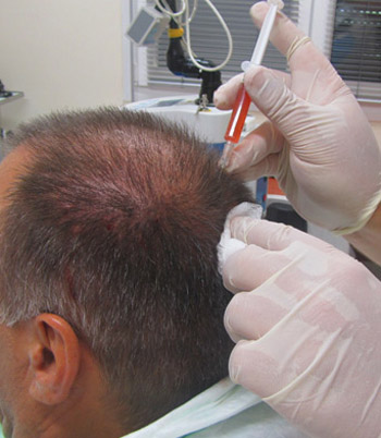 Systematic Review of PRP as a Genetic Hair Loss Treatment