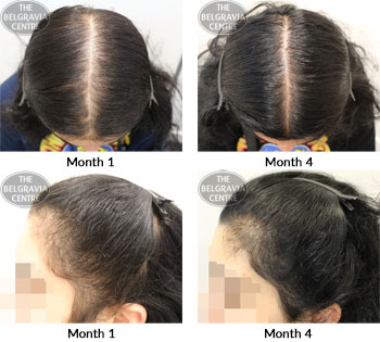 alert female pattern hair loss the belgravia centre 12 09 2018