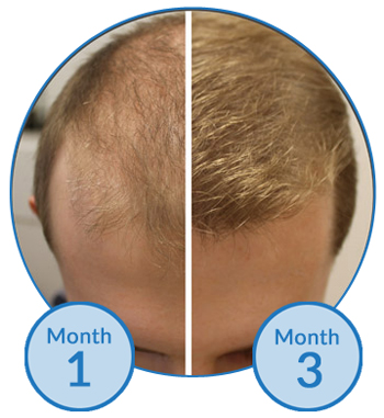 Thinning Hair Before and After Male Hair Loss Treatment at The Belgravia Centre - Success