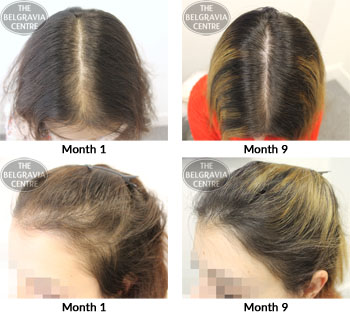 alert female pattern hair loss the belgravia centre 17 08 2018