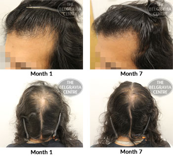 alert male pattern hair loss the belgravia centre 13 08 2018