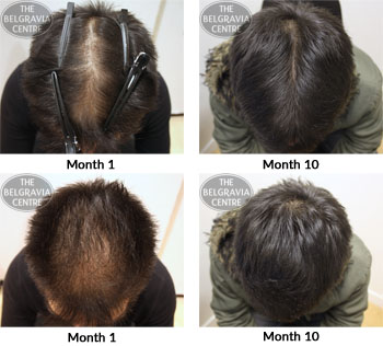 alert male pattern hair loss the belgravia centre 30 07 2018