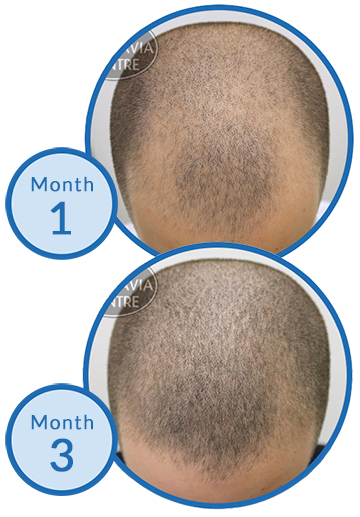 Thinning Hair Male Pattern Baldness men's hair loss treatment success story Belgravia Centre