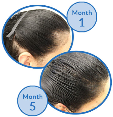 Belgravia Centre post partum alopecia female hair loss before and after client photos success story