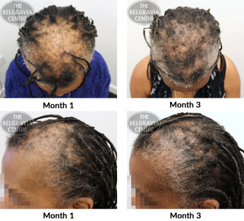 alert female pattern hair loss and hair breakage the belgravia centre 12 07 2018