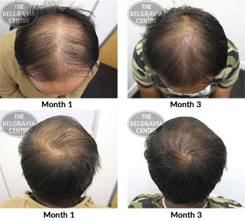 alert male pattern hair loss the belgravia centre 13 06 2018