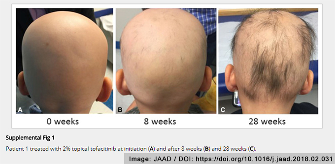 childrens hair loss treatment trial tofacitinib solution alopecia areata topical jak inhibitor