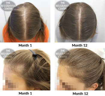 alert female pattern hair loss the belgravia centre 01 06 2018