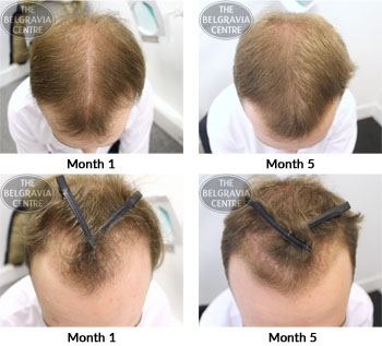 alert male pattern hair loss the belgravia centre 01 06 2018